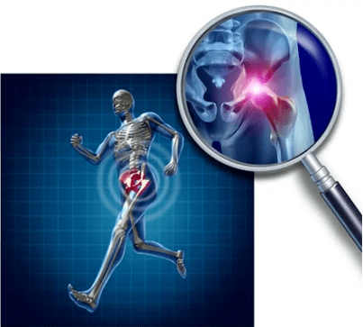 Arthrose des articulations de la hanche