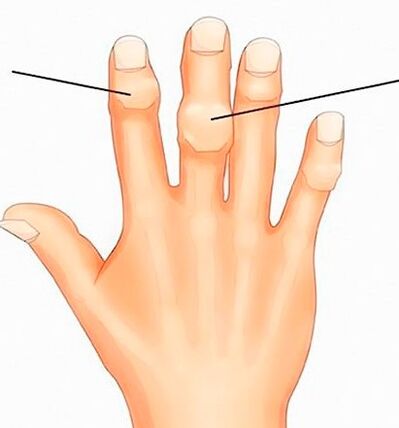 Noeuds d'Heberden et de Bouchard sur les articulations interphalangiennes avec arthrose