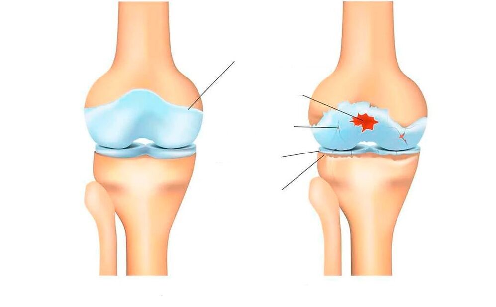 articulation saine et souffrant d'arthrose
