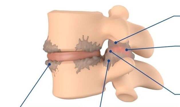 modifications tissulaires dans la spondylarthrose