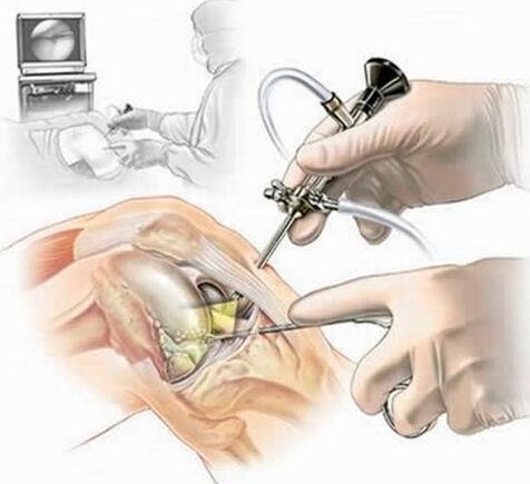 Fonctionnement sur l'articulation du genou - Arthroscopie