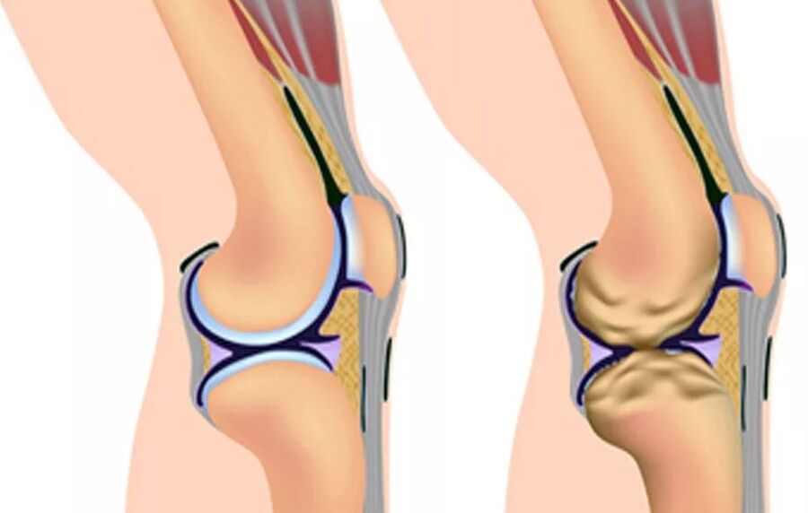 Le premier degré d'arthrose du genou