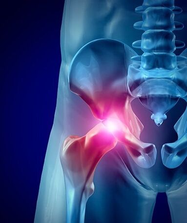 douleur à la hanche photo 1