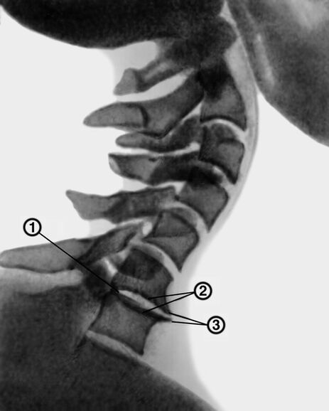 Radiographie de la colonne cervicale avec ostéochondrose